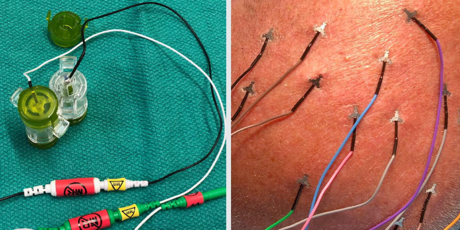 MRI safe scalp electrodes
