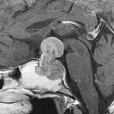 Pituitary Tumors
