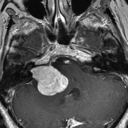 Schwannoma